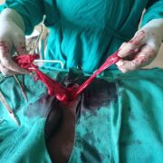 Visit to Wabane: A case of Strangulated Inguinal Hernia in Wabane